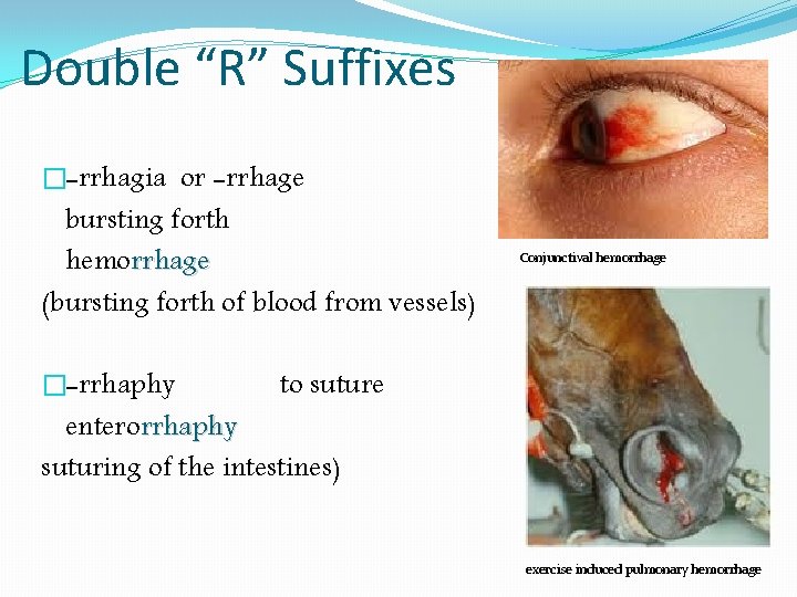 Double “R” Suffixes �-rrhagia or -rrhage bursting forth hemorrhage (bursting forth of blood from