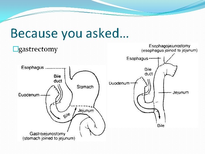Because you asked… �gastrectomy 