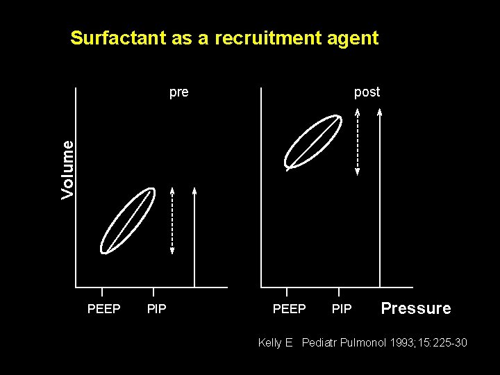 Surfactant as a recruitment agent post Volume pre PEEP PIP Pressure Kelly E Pediatr
