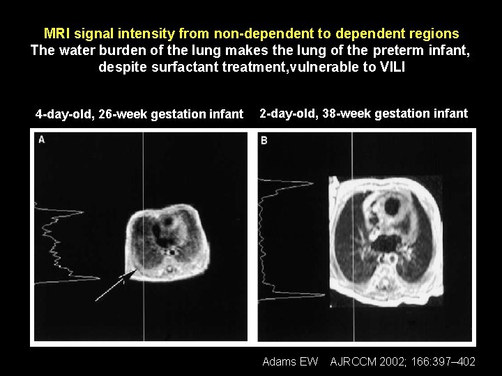 MRI signal intensity from non-dependent to dependent regions The water burden of the lung
