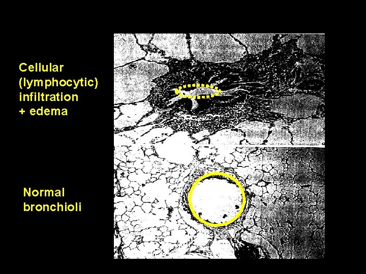Cellular (lymphocytic) infiltration + edema Normal bronchioli 