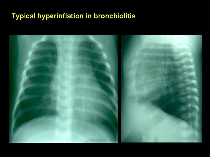 Typical hyperinflation in bronchiolitis 