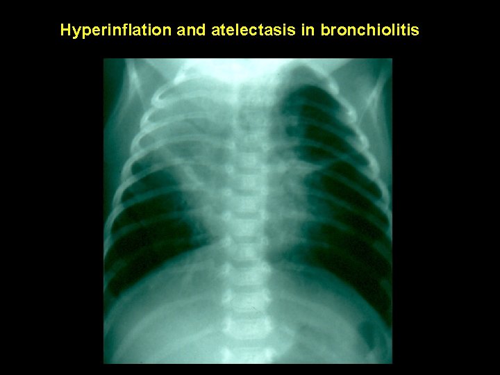 Hyperinflation and atelectasis in bronchiolitis 