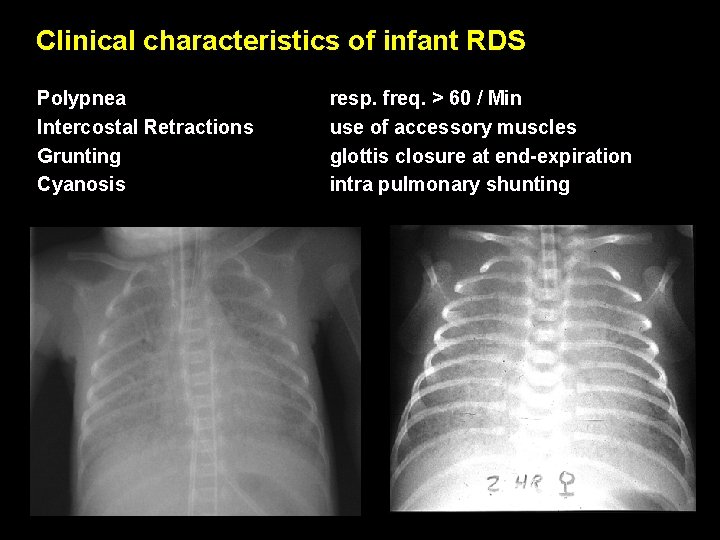 Clinical characteristics of infant RDS Polypnea Intercostal Retractions Grunting Cyanosis resp. freq. > 60
