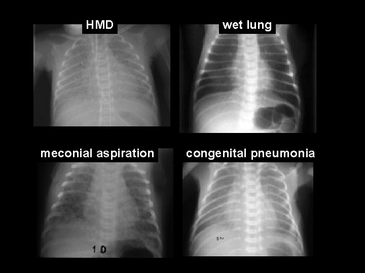 HMD wet lung meconial aspiration congenital pneumonia 
