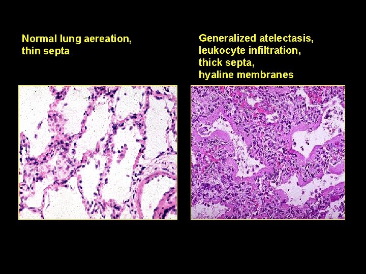 Normal lung aereation, thin septa Generalized atelectasis, leukocyte infiltration, thick septa, hyaline membranes 