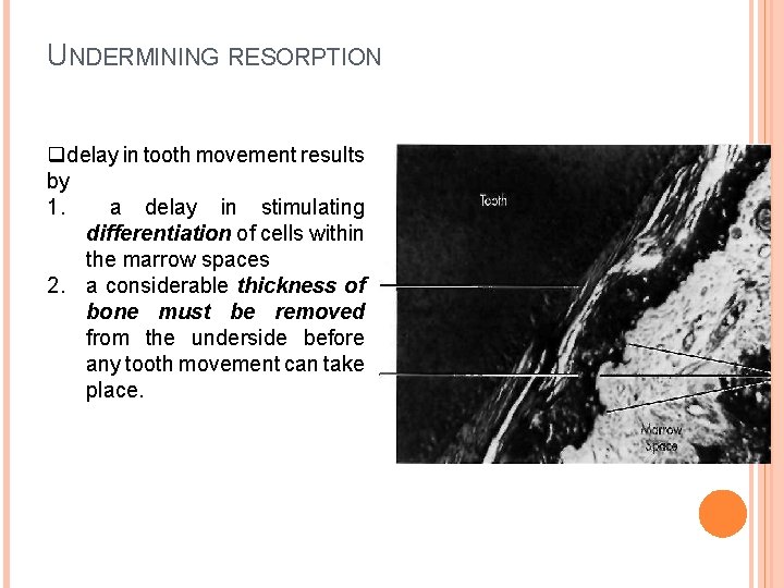 UNDERMINING RESORPTION qdelay in tooth movement results by 1. a delay in stimulating differentiation