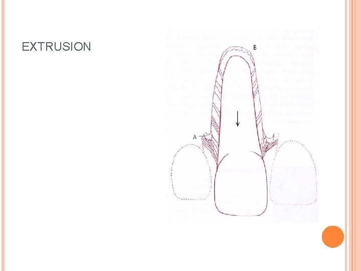 EXTRUSION 