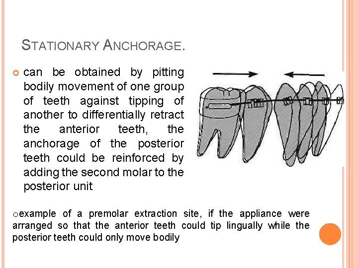 STATIONARY ANCHORAGE. can be obtained by pitting bodily movement of one group of teeth