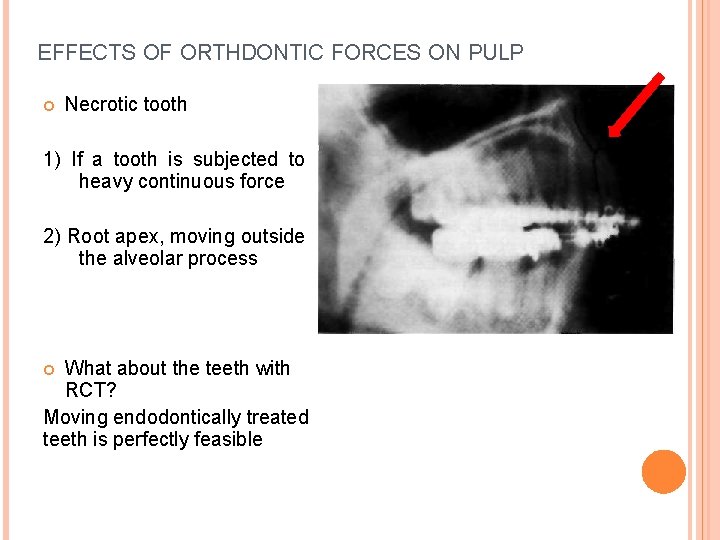 EFFECTS OF ORTHDONTIC FORCES ON PULP Necrotic tooth 1) If a tooth is subjected