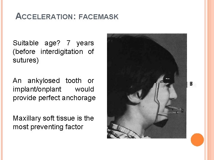 ACCELERATION: FACEMASK Suitable age? 7 years (before interdigitation of sutures) An ankylosed tooth or