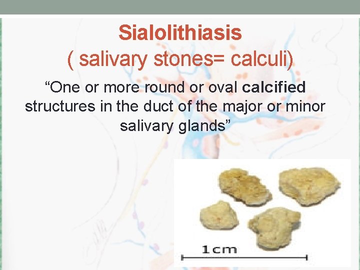 Sialolithiasis ( salivary stones= calculi) “One or more round or oval calcified structures in