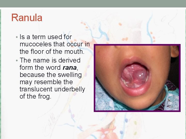 Ranula • Is a term used for mucoceles that occur in the floor of