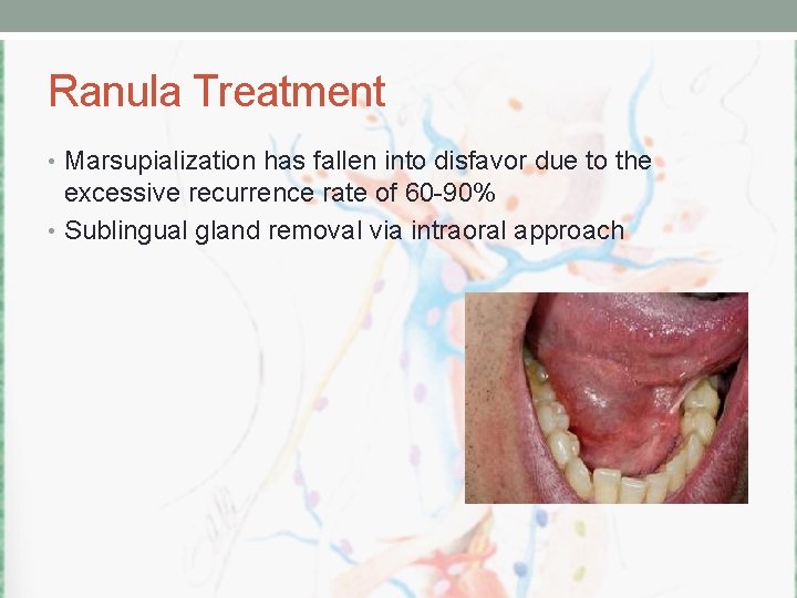Ranula Treatment • Marsupialization has fallen into disfavor due to the excessive recurrence rate