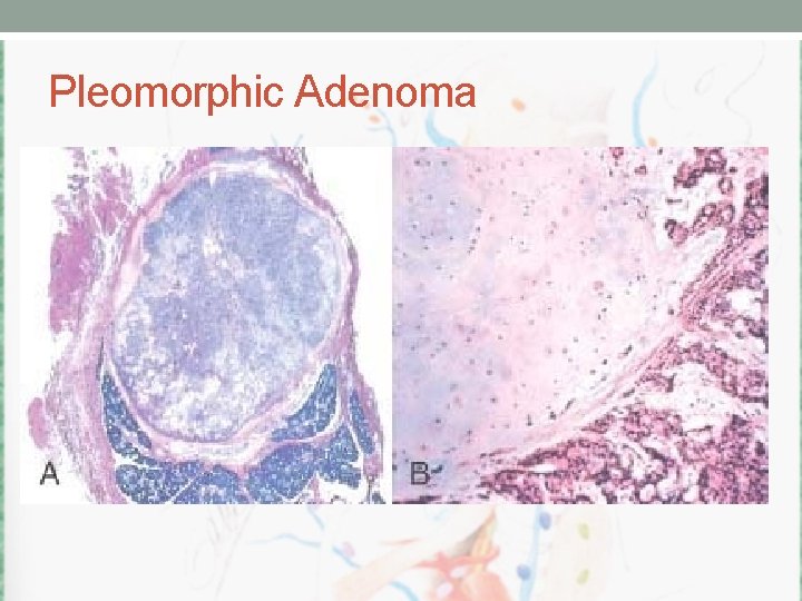 Pleomorphic Adenoma 