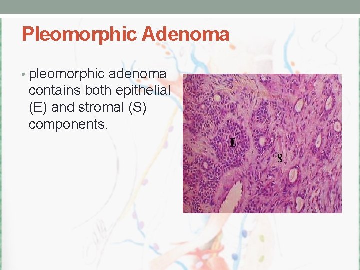 Pleomorphic Adenoma • pleomorphic adenoma contains both epithelial (E) and stromal (S) components. 