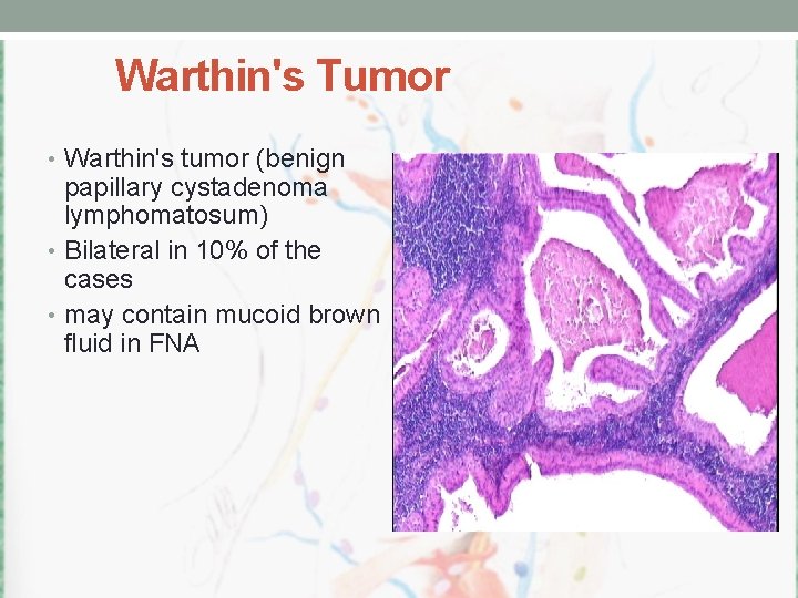 Warthin's Tumor • Warthin's tumor (benign papillary cystadenoma lymphomatosum) • Bilateral in 10% of