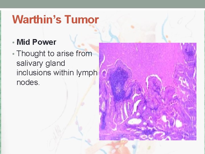 Warthin’s Tumor • Mid Power • Thought to arise from salivary gland inclusions within