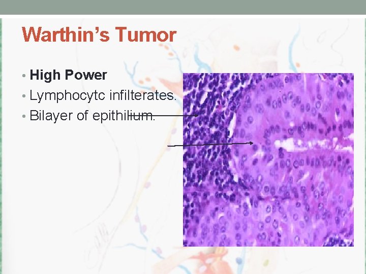 Warthin’s Tumor • High Power • Lymphocytc infilterates. • Bilayer of epithilium. 