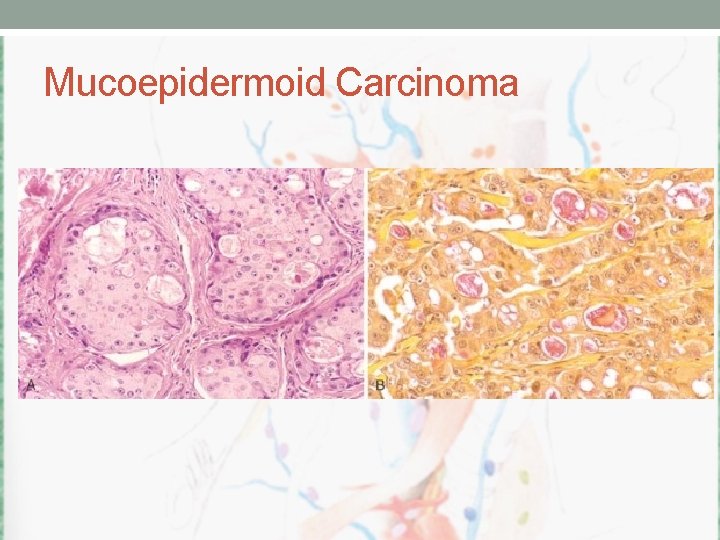 Mucoepidermoid Carcinoma 