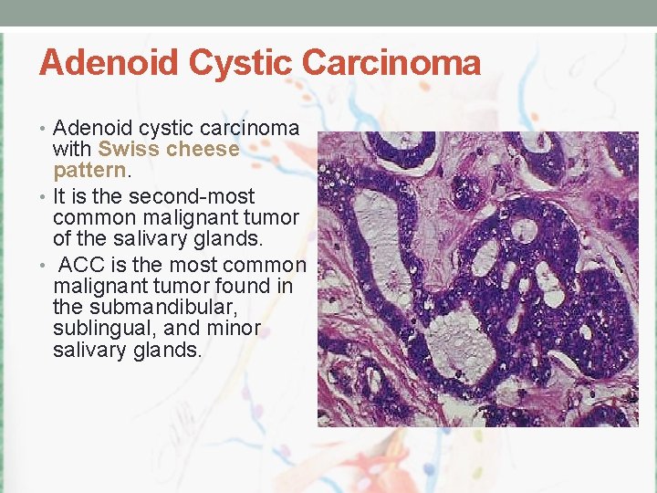 Adenoid Cystic Carcinoma • Adenoid cystic carcinoma with Swiss cheese pattern. • It is