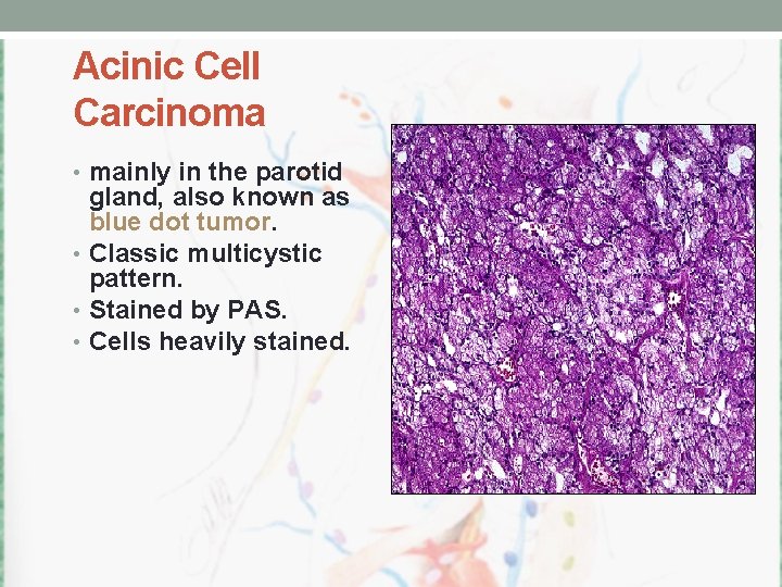 Acinic Cell Carcinoma • mainly in the parotid gland, also known as blue dot