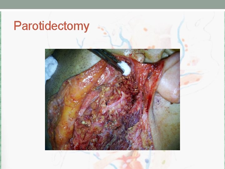 Parotidectomy 