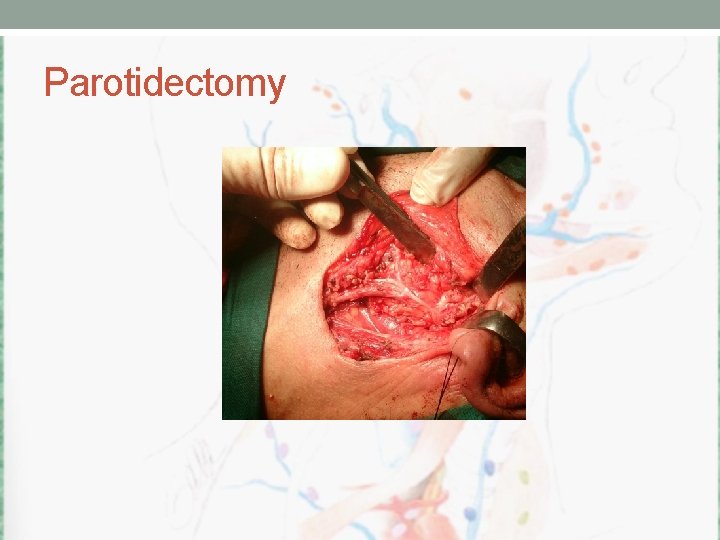 Parotidectomy 