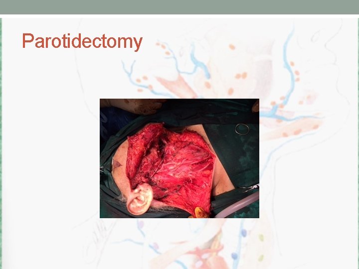 Parotidectomy 