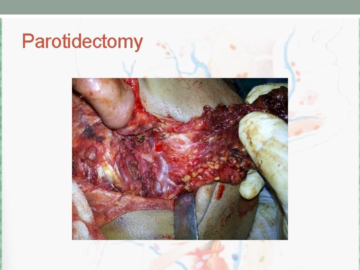Parotidectomy 
