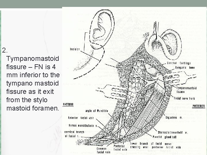 2. Tympanomastoid fissure – FN is 4 mm inferior to the tympano mastoid fissure