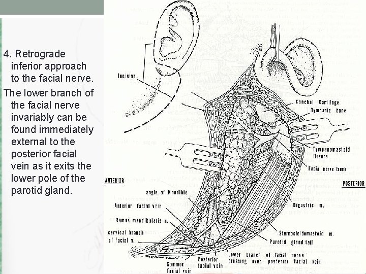 4. Retrograde inferior approach to the facial nerve. The lower branch of the facial