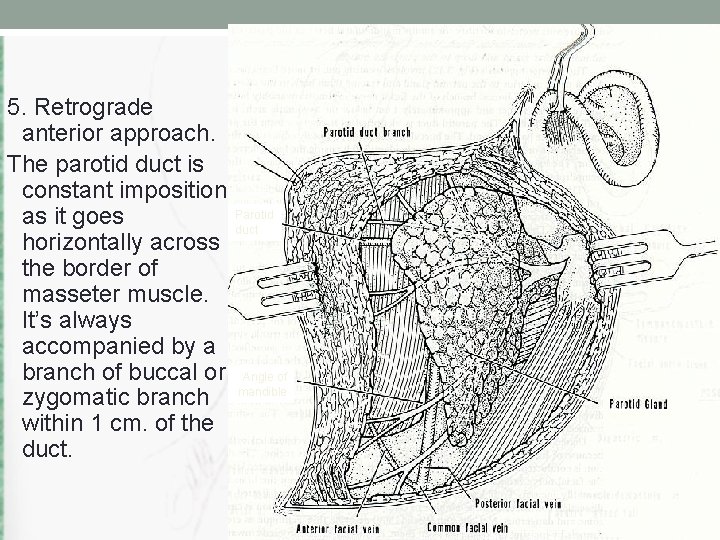 5. Retrograde anterior approach. The parotid duct is constant imposition Parotid as it goes