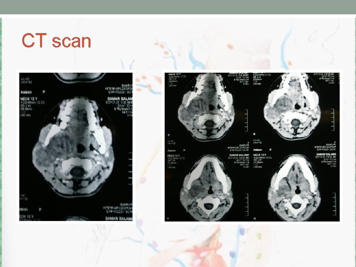 CT scan 