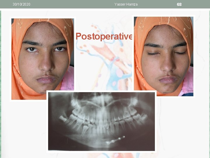 30/10/2020 Yasser Hamza Postoperative 68 