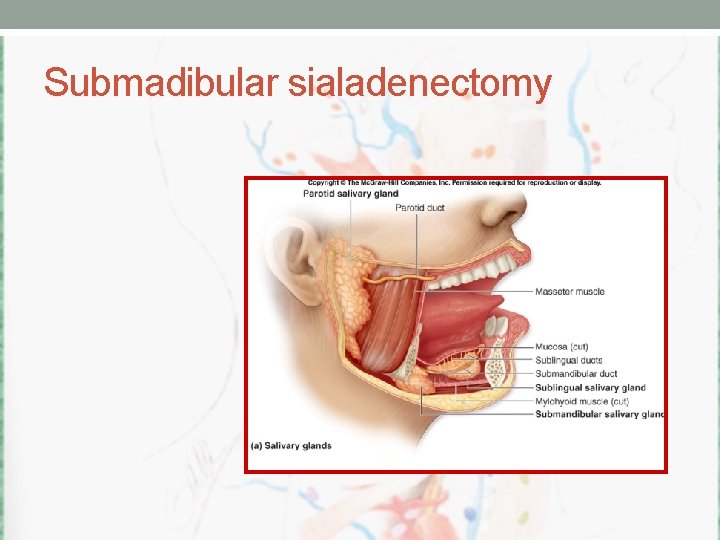 Submadibular sialadenectomy 