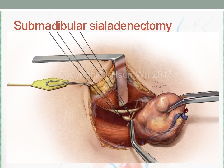 Submadibular sialadenectomy 