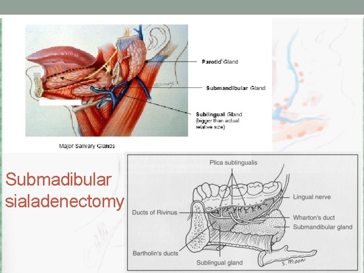 Submadibular sialadenectomy 