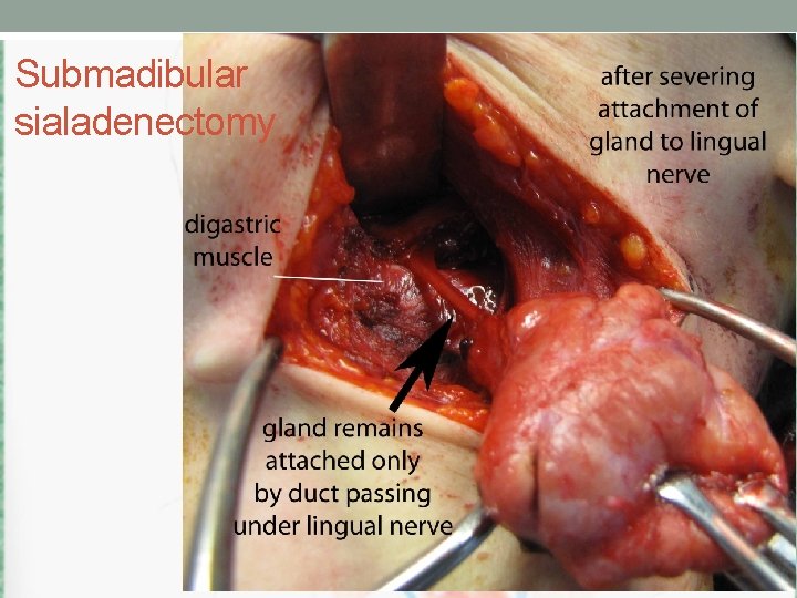 Submadibular sialadenectomy 