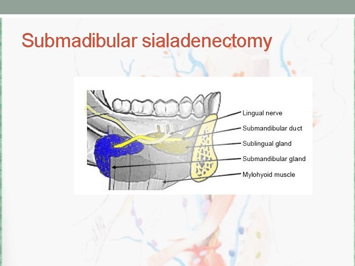 Submadibular sialadenectomy 