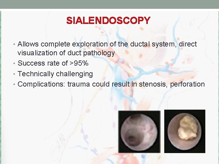 SIALENDOSCOPY • Allows complete exploration of the ductal system, direct visualization of duct pathology