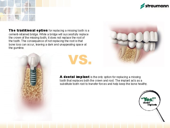 The traditional option for replacing a missing tooth is a cement-retained bridge. While a