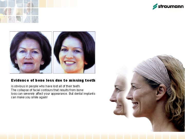 Evidence of bone loss due to missing teeth is obvious in people who have