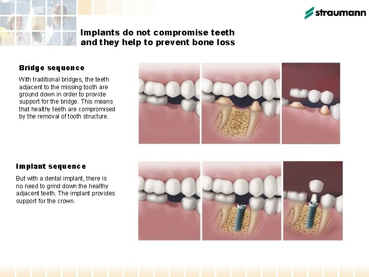 Implants do not compromise teeth and they help to prevent bone loss Bridge sequence