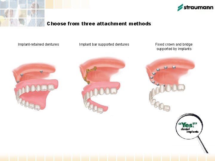 Choose from three attachment methods Implant-retained dentures Implant bar supported dentures Fixed crown and