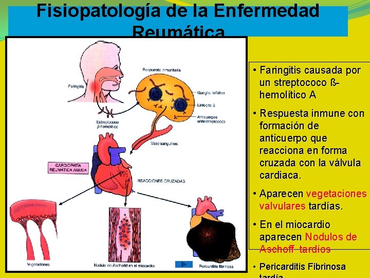 Fisiopatología de la Enfermedad Reumática • Faringitis causada por un streptococo ßhemolítico A • Fisiopatología de la Enfermedad Reumática • Faringitis causada por un streptococo ßhemolítico A •