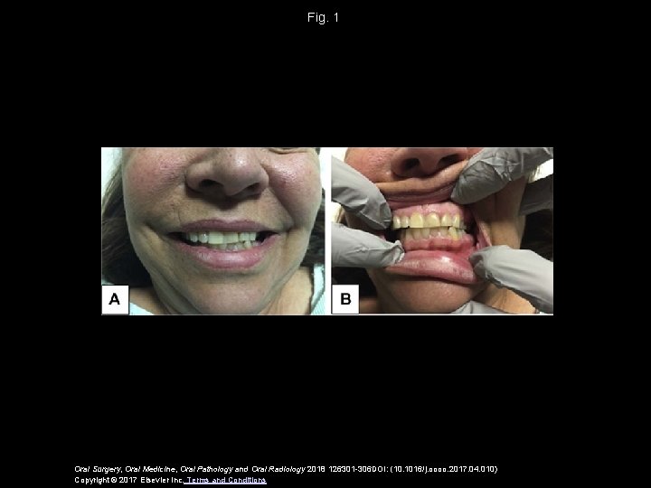 Fig. 1 Oral Surgery, Oral Medicine, Oral Pathology and Oral Radiology 2018 126301 -306