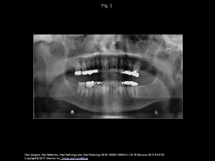 Fig. 2 Oral Surgery, Oral Medicine, Oral Pathology and Oral Radiology 2018 126301 -306