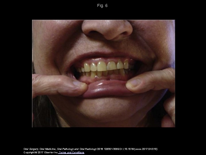 Fig. 6 Oral Surgery, Oral Medicine, Oral Pathology and Oral Radiology 2018 126301 -306
