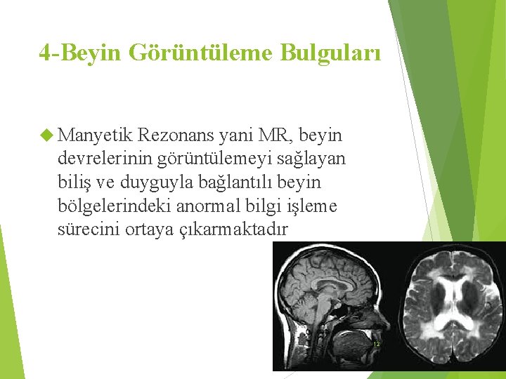 4 -Beyin Görüntüleme Bulguları Manyetik Rezonans yani MR, beyin devrelerinin görüntülemeyi sağlayan biliş ve